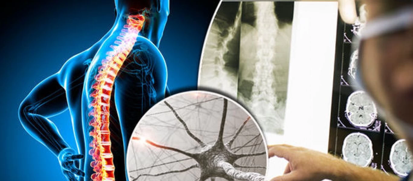 Νόσος κινητικού νευρώνα: Τι πρέπει να κάνετε αν νιώσετε αδυναμία στις αρθρώσεις